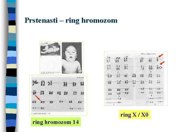 Prstenasti – ring hromozom ring X / X 0 ring hromozom 14 