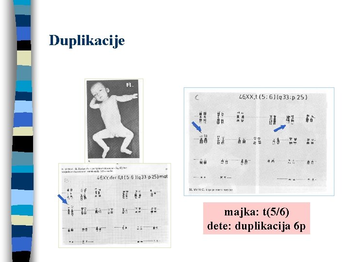 Duplikacije majka: t(5/6) dete: duplikacija 6 p 