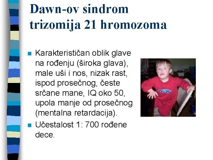 Dawn-ov sindrom trizomija 21 hromozoma n n Karakterističan oblik glave na rođenju (široka glava),