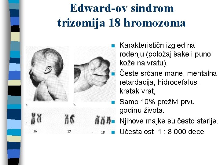 Edward-ov sindrom trizomija 18 hromozoma n n n Karakterističn izgled na rođenju (položaj šake