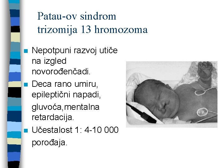 Patau-ov sindrom trizomija 13 hromozoma n n n Nepotpuni razvoj utiče na izgled novorođenčadi.