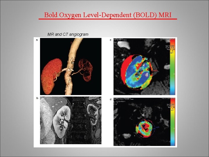 Bold Oxygen Level-Dependent (BOLD) MRI MR and CT angiogram 