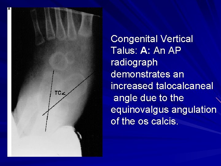 Congenital Vertical Talus: A: An AP radiograph demonstrates an increased talocalcaneal angle due to