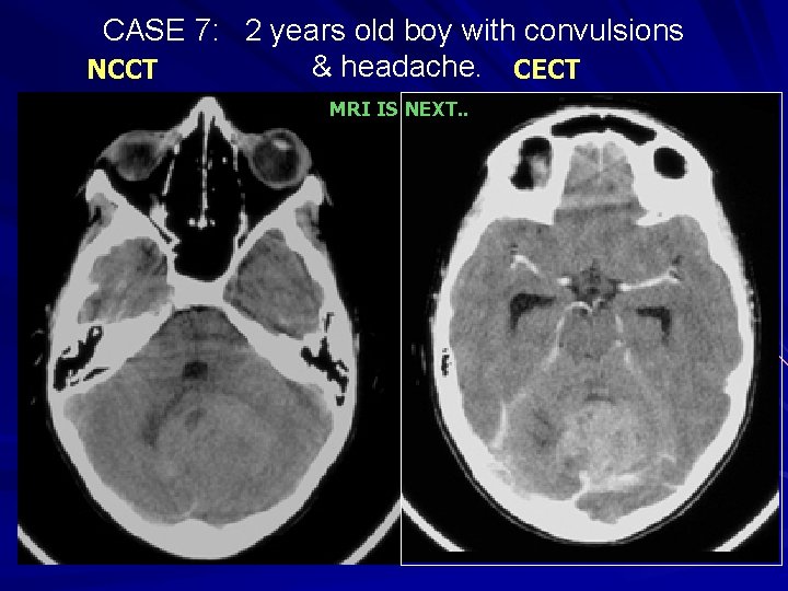 CASE 7: 2 years old boy with convulsions & headache. CECT NCCT MRI IS