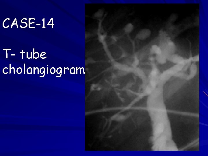 CASE-14 T- tube cholangiogram 