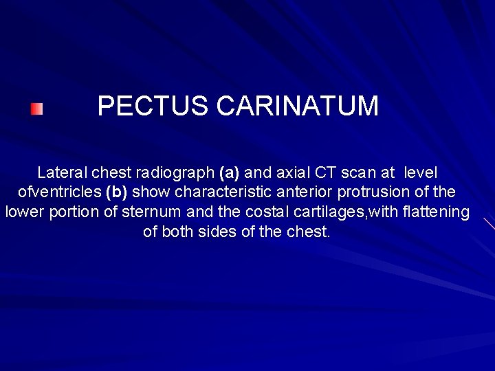 PECTUS CARINATUM Lateral chest radiograph (a) and axial CT scan at level ofventricles (b)