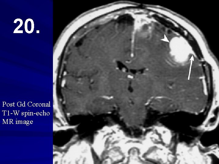 20. Post Gd Coronal T 1 -W spin-echo MR image 