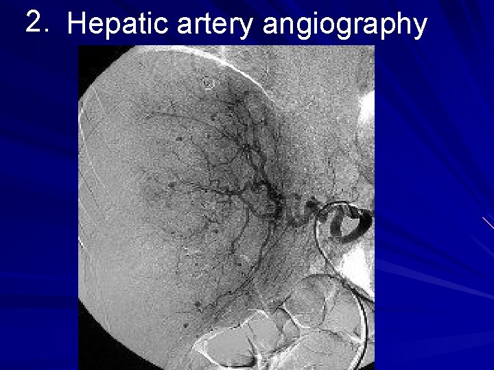 2. Hepatic artery angiography 