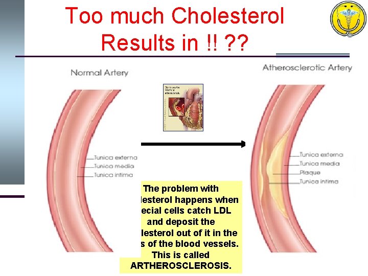 Too much Cholesterol Results in !! ? ? LDL The problem with cholesterol happens