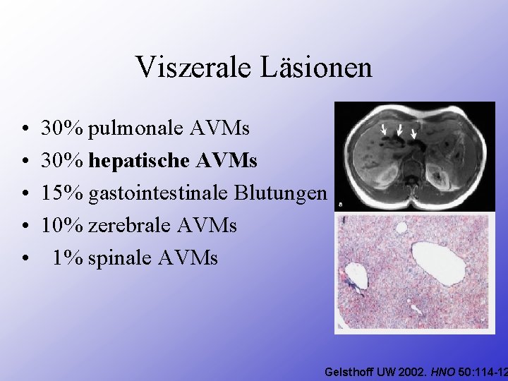 Viszerale Läsionen • • • 30% pulmonale AVMs 30% hepatische AVMs 15% gastointestinale Blutungen