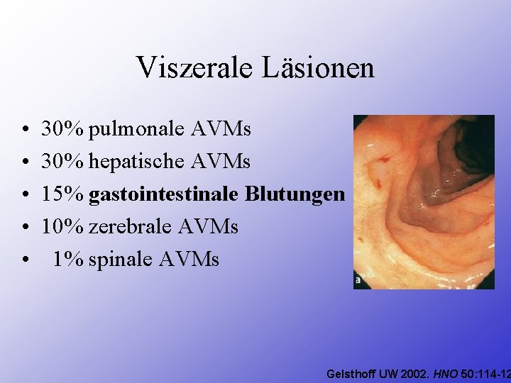 Viszerale Läsionen • • • 30% pulmonale AVMs 30% hepatische AVMs 15% gastointestinale Blutungen