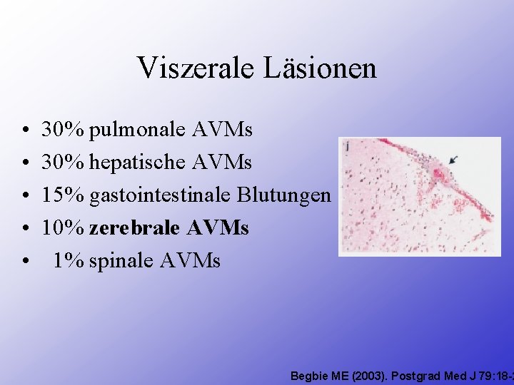 Viszerale Läsionen • • • 30% pulmonale AVMs 30% hepatische AVMs 15% gastointestinale Blutungen