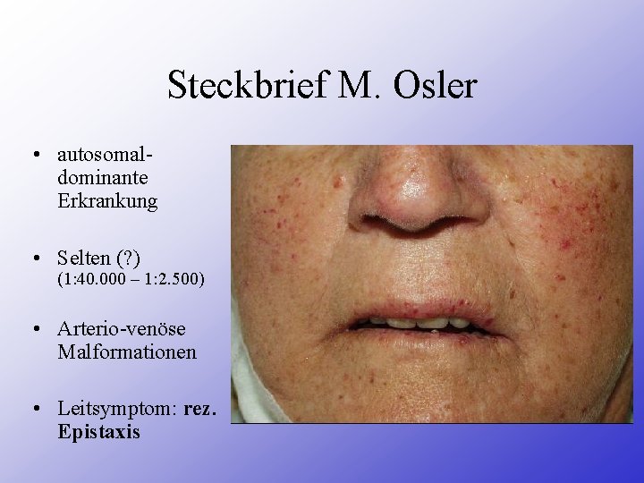 Steckbrief M. Osler • autosomaldominante Erkrankung • Selten (? ) (1: 40. 000 –