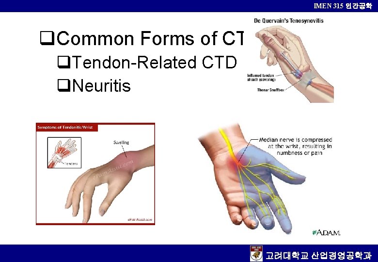 IMEN 315 인간공학 q. Common Forms of CTD q. Tendon-Related CTD q. Neuritis 고려대학교