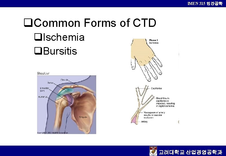 IMEN 315 인간공학 q. Common Forms of CTD q. Ischemia q. Bursitis 고려대학교 산업경영공학과