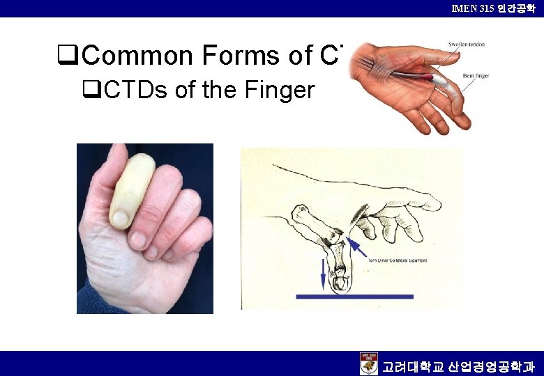 IMEN 315 인간공학 q. Common Forms of CTD q. CTDs of the Finger 고려대학교