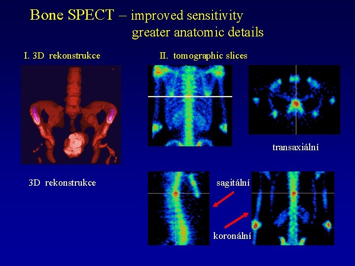 Bone SPECT – improved sensitivity greater anatomic details I. 3 D rekonstrukce II. tomographic