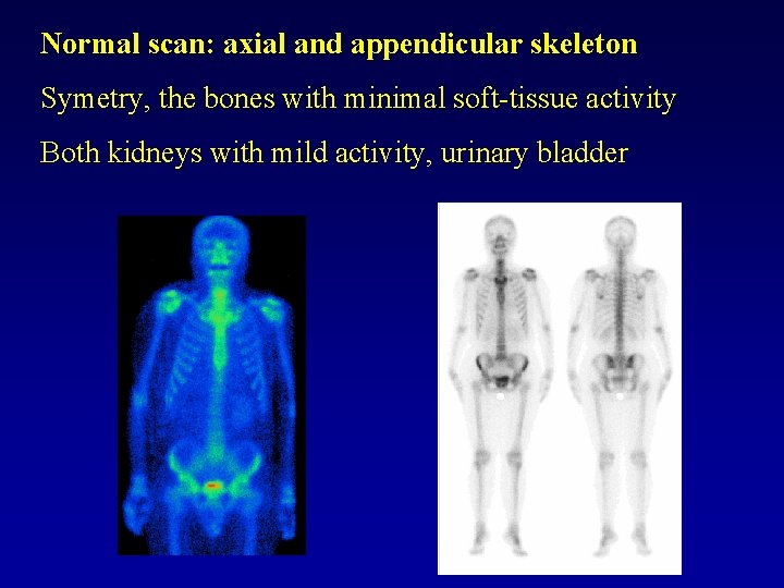 Normal scan: axial and appendicular skeleton Symetry, the bones with minimal soft-tissue activity Both