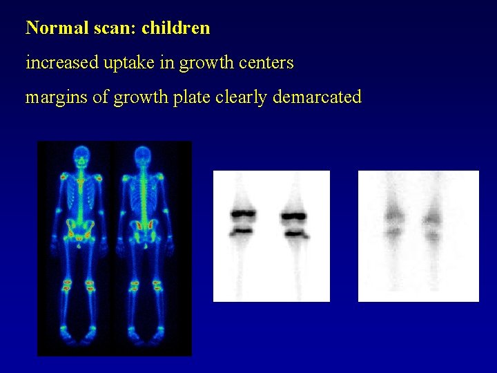 Normal scan: children increased uptake in growth centers margins of growth plate clearly demarcated