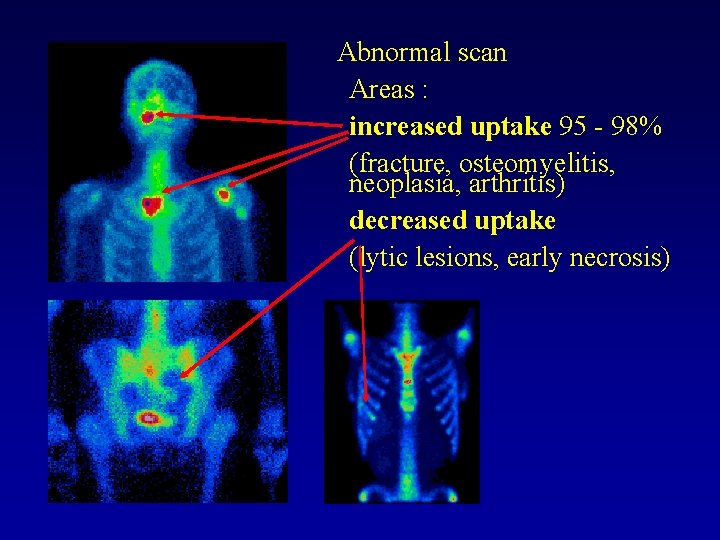 Abnormal scan Areas : increased uptake 95 - 98% (fracture, osteomyelitis, neoplasia, arthritis) decreased