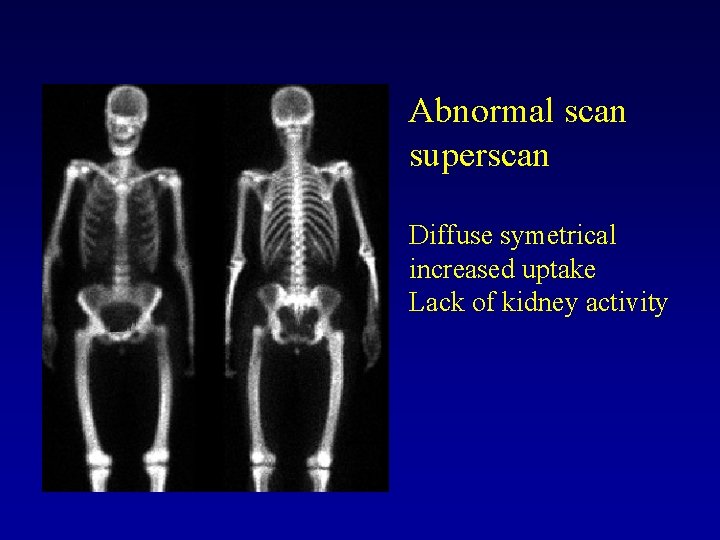 Abnormal scan superscan Diffuse symetrical increased uptake Lack of kidney activity 