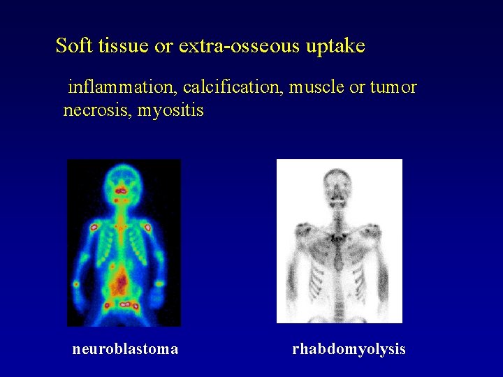 Soft tissue or extra-osseous uptake inflammation, calcification, muscle or tumor necrosis, myositis neuroblastoma rhabdomyolysis