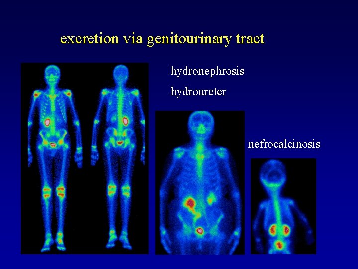 excretion via genitourinary tract hydronephrosis hydroureter nefrocalcinosis 