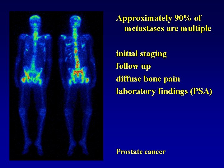 Approximately 90% of metastases are multiple initial staging follow up diffuse bone pain laboratory
