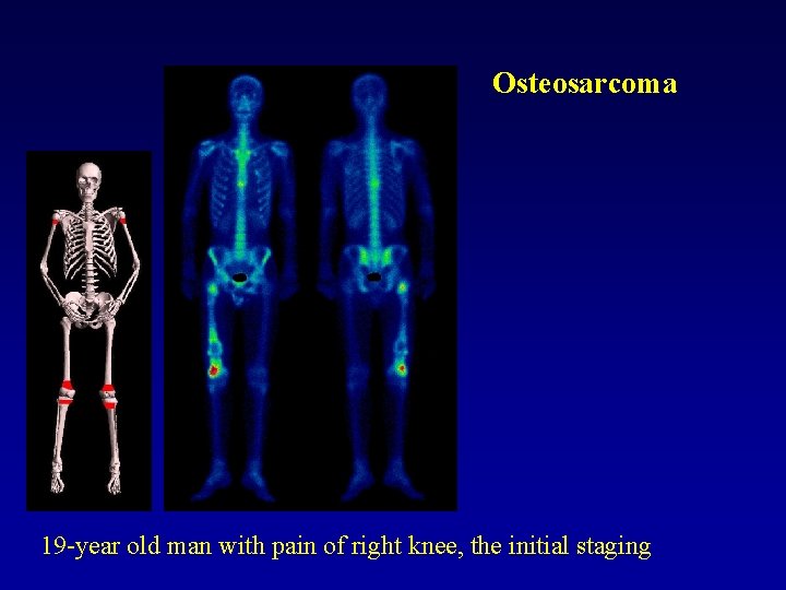 Osteosarcoma 19 -year old man with pain of right knee, the initial staging 