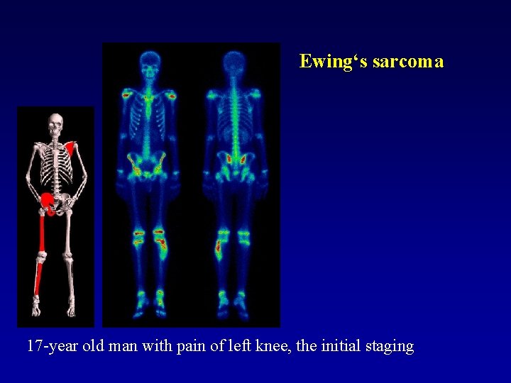 Ewing‘s sarcoma 17 -year old man with pain of left knee, the initial staging