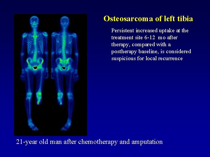 Osteosarcoma of left tibia Persistent increased uptake at the treatment site 6 -12 mo