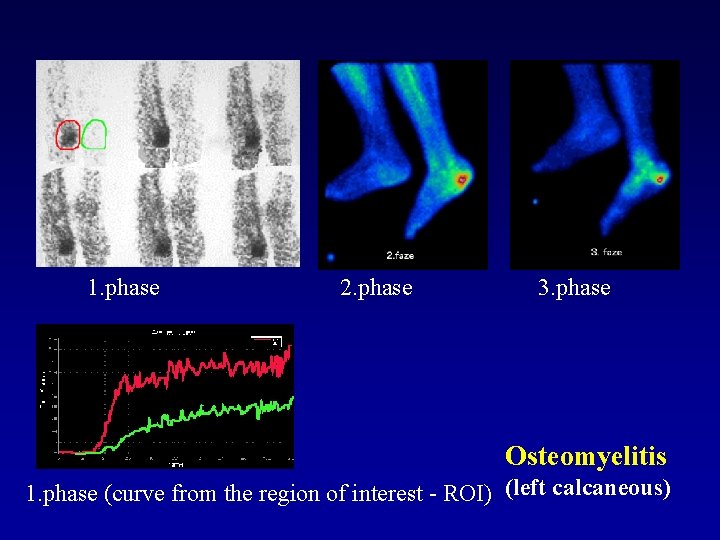 1. phase 2. phase 3. phase Osteomyelitis 1. phase (curve from the region of