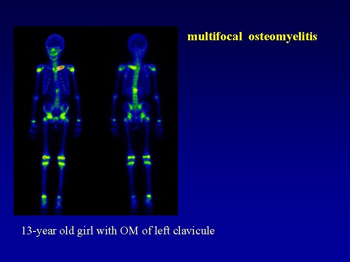 multifocal osteomyelitis 13 -year old girl with OM of left clavicule 