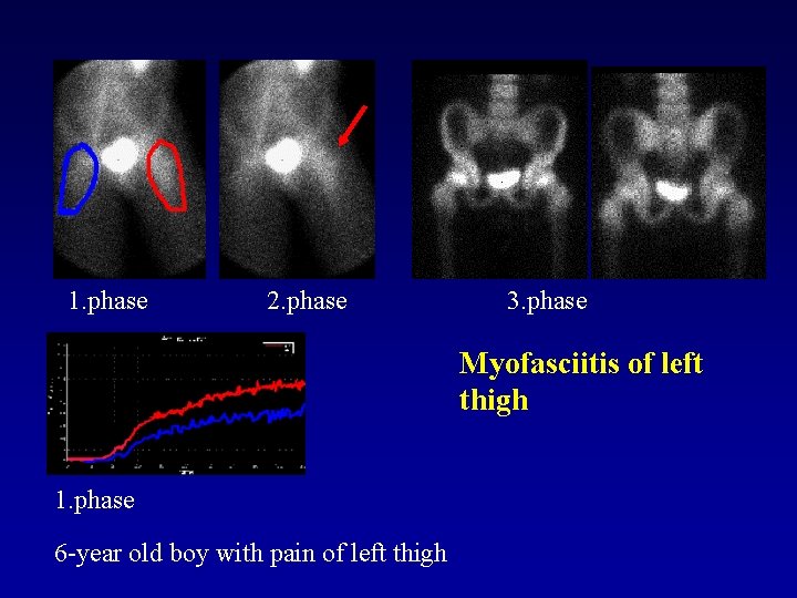 1. phase 2. phase 3. phase Myofasciitis of left thigh 1. phase 6 -year