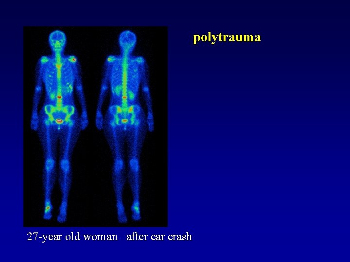 polytrauma 27 -year old woman after car crash 