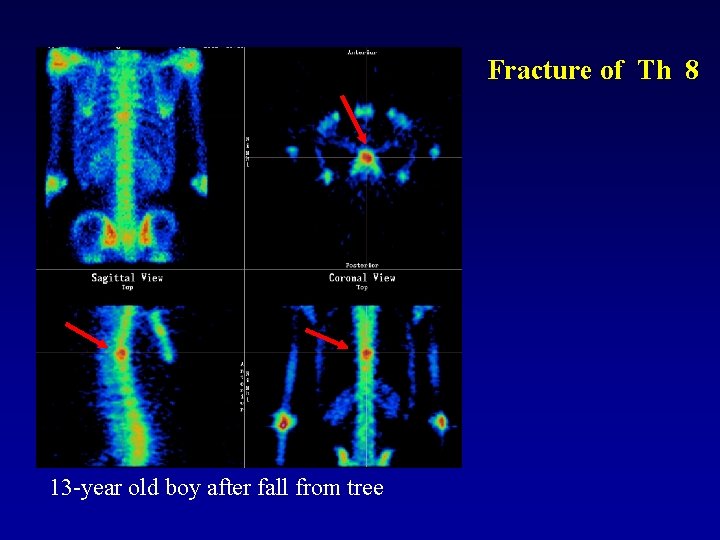 Fracture of Th 8 13 -year old boy after fall from tree 