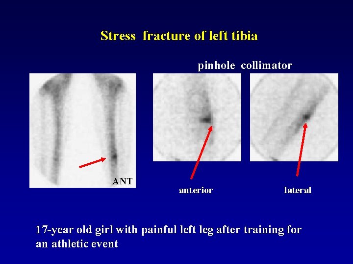 Stress fracture of left tibia pinhole collimator ANT anterior lateral 17 -year old girl