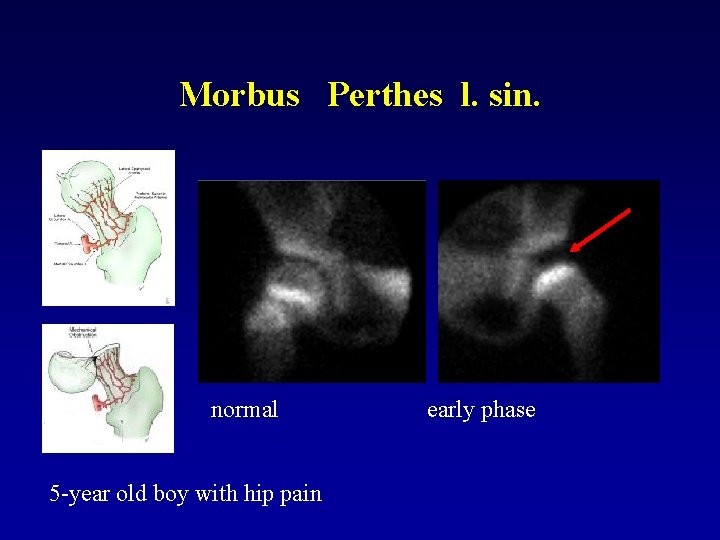 Morbus Perthes l. sin. normal 5 -year old boy with hip pain early phase