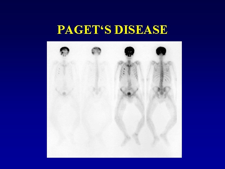 PAGET‘S DISEASE 