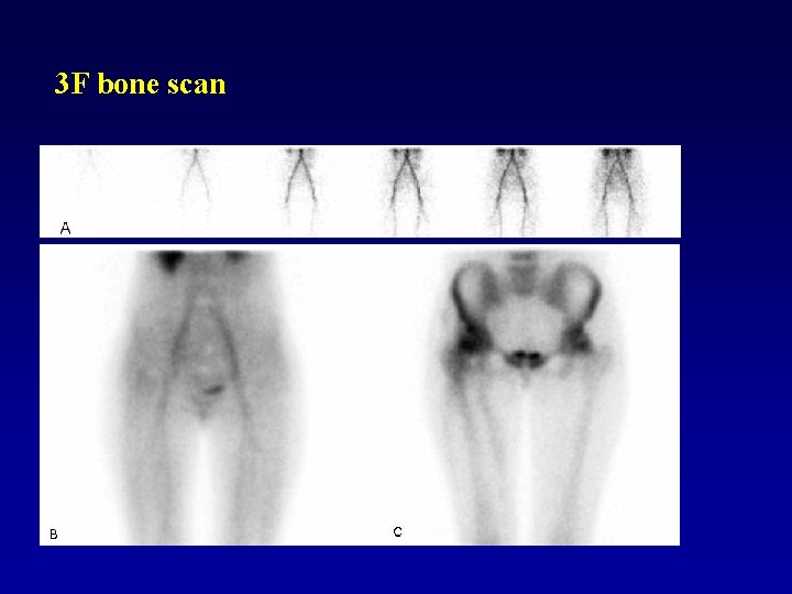 3 F bone scan 