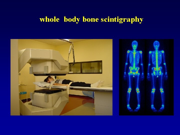 whole body bone scintigraphy 