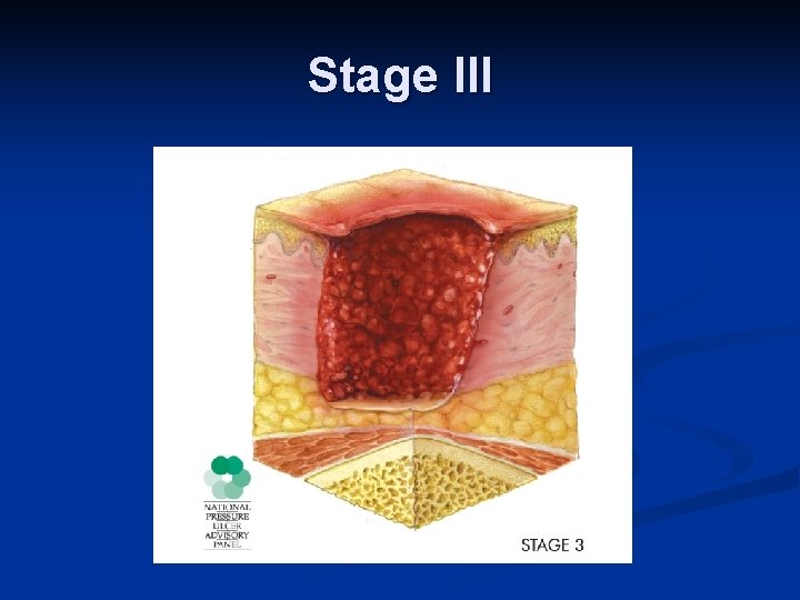 Stage III 