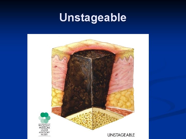 Unstageable 