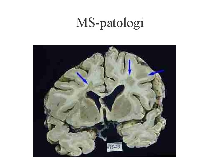 MS-patologi 