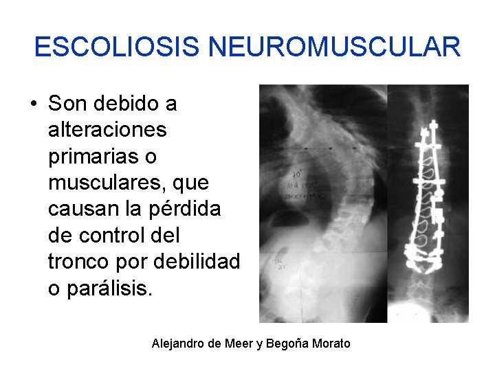 ESCOLIOSIS NEUROMUSCULAR • Son debido a alteraciones primarias o musculares, que causan la pérdida