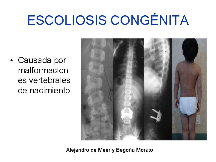 ESCOLIOSIS CONGÉNITA • Causada por malformacion es vertebrales de nacimiento. Alejandro de Meer y