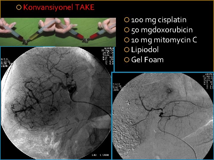  Konvansiyonel TAKE 100 mg cisplatin 50 mgdoxorubicin 10 mg mitomycin C Lipiodol Gel