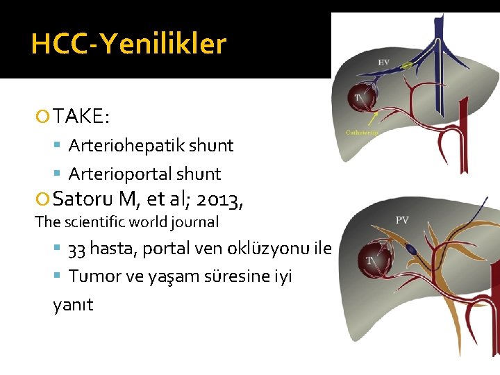 HCC-Yenilikler TAKE: Arteriohepatik shunt Arterioportal shunt Satoru M, et al; 2013, The scientific world