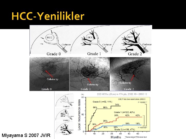 HCC-Yenilikler Miyayama S 2007 JVIR 