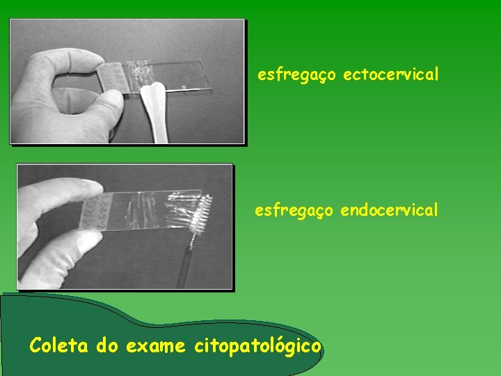 esfregaço ectocervical esfregaço endocervical Coleta do exame citopatológico 